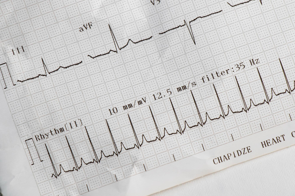 Electrocardiogram (EKG)